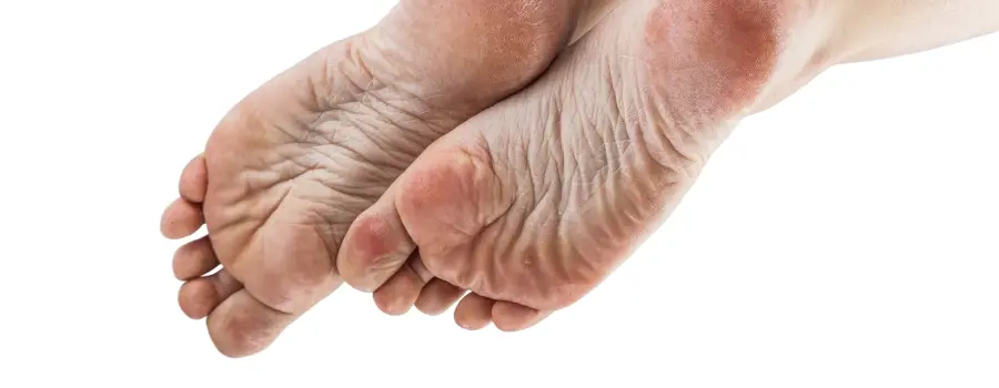 Mykózy nohou a nehtů