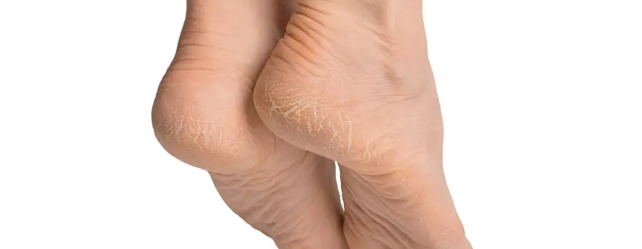 Popraskané paty a suchá kůže