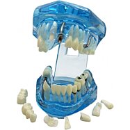 Model chrupu, zubních implantátů