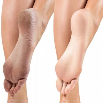 Gehwol Schrunden Masť - Intenzivní mast na popraskanou a ztvrdlou pokožku chodidel 75ml