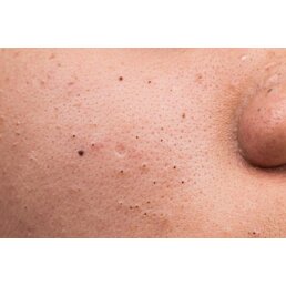 Kosmetický nástroj na odstraňování černých teček a akné - Náhled