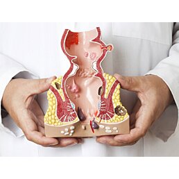 Průřezový model konečníku, hemoroidy (zvětšené) s patologiemi - Náhled