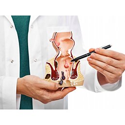 Průřezový model konečníku, hemoroidy (zvětšené) s patologiemi