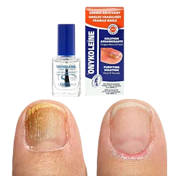Roztok na mykózou oslabené nehty, Onykoleine - 10 ml - Náhled