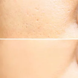 Bezdrátový kavitační sonický čistič pleti 3 v 1 - Náhled