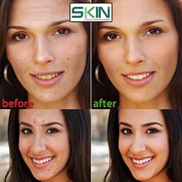 Sada nástrojů na čištění, vytlačování a odstranění akné v pouzdře se zrcadlem - Náhled