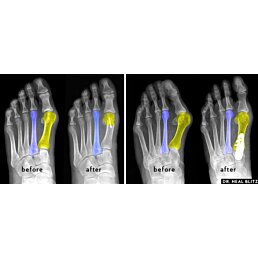 Dlahy na korekci vybočeného palce, výrůstků a puchýřů hallux - bílá 2ks - Náhled