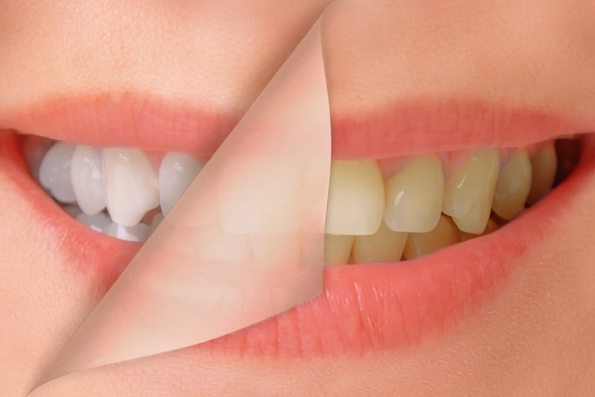 Grafické porovnání žlutých a bílých zubů jako symbol prevence zažloutnutí.