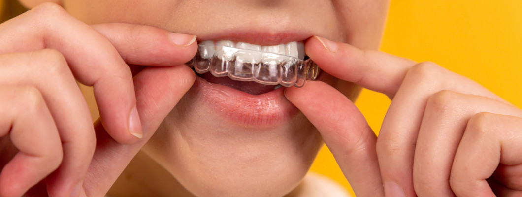 Žena si nasazuje dlahu určenou k bělení zubů.